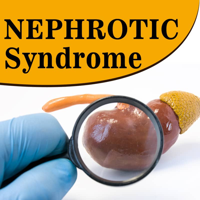 Nephrotic syndrome ayurvedic treatment