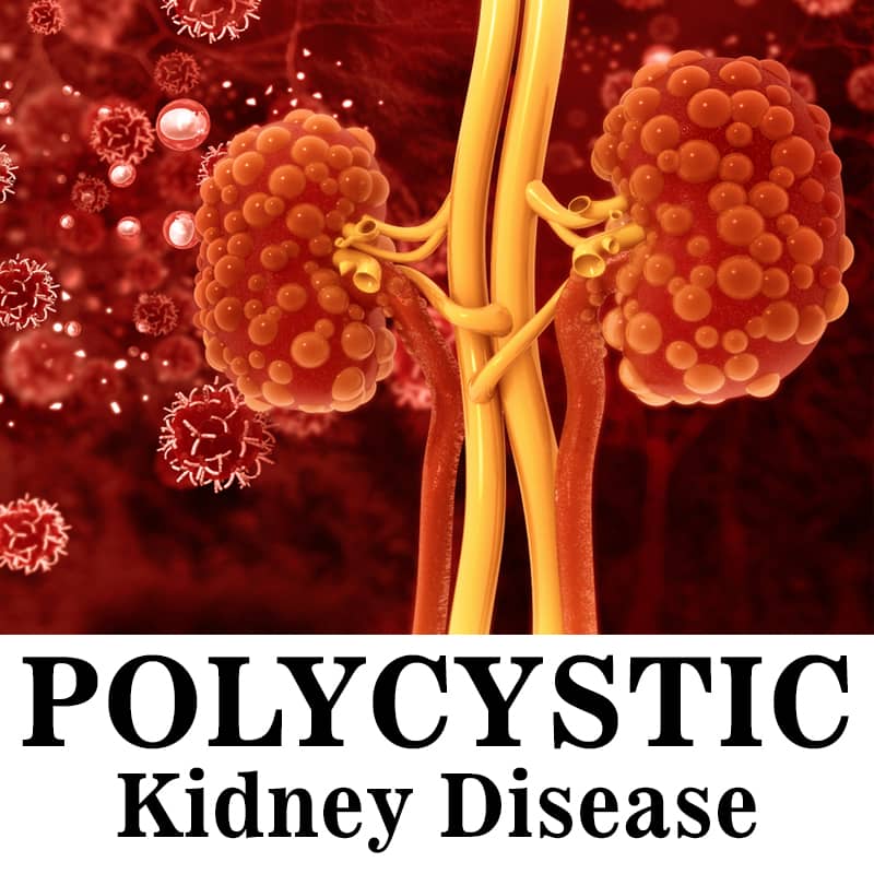 Polycystic kidney disease treatment in ayurveda